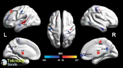 MR taramalarını analiz etmek için geliştirilen yeni metodoloji sayesinde; ilk kez, otizmli bireyler ve otizmli olmayan bireylerin beyinleri arasındaki işlevsel farklılıklar ayrıştırıldı.